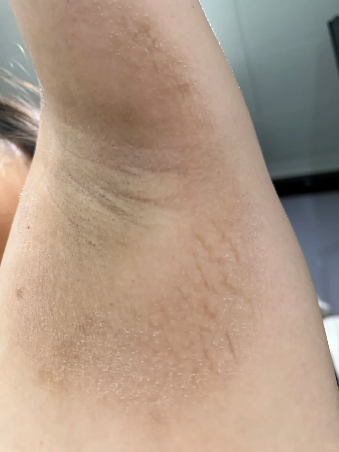 腋毛處晶狀顆粒狀態照片